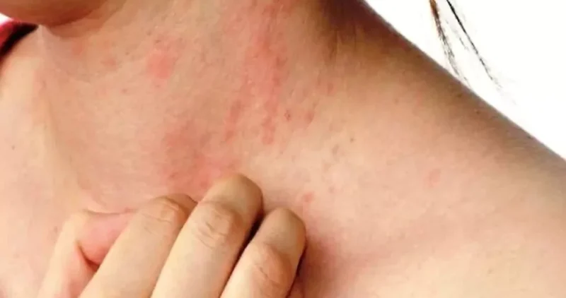 Summer Skin Problems Prickly Heat and Heat Boils Summer Skin Problems: How To Prevent Heat Boils On Face