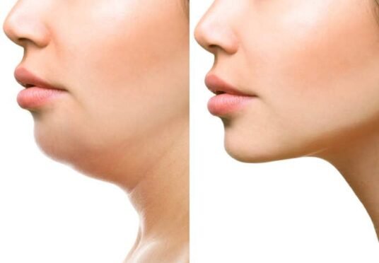 Double Chin Reduction Treatments in hyderabad | Arna Clinic Double Chin Reduction