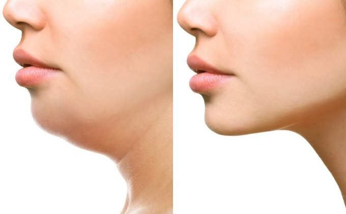 Double Chin Reduction Treatments in hyderabad | Arna Clinic Double Chin Reduction