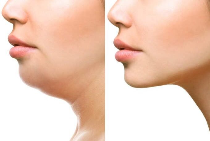 Double Chin Reduction