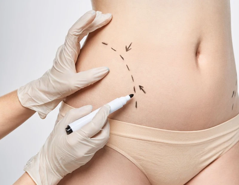 Injection lipolysis
