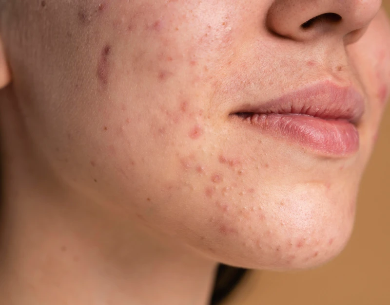 acne scars