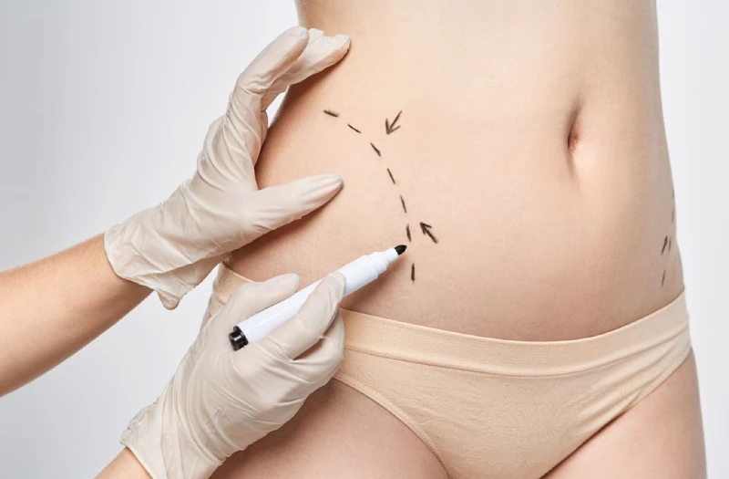 tummy tuck